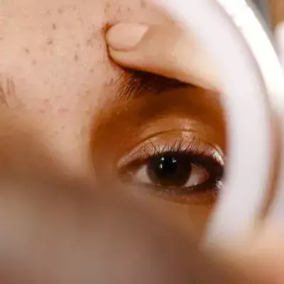 These Six Skin Conditions Are Commonly Mistaken For Acne 