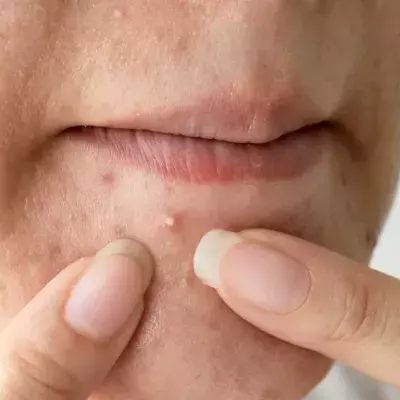 Understanding the Six Types of Acne and How To Treat Them