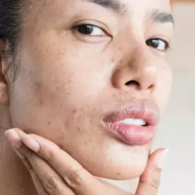 Understanding What Triggers Hormonal Acne and How To Treat It