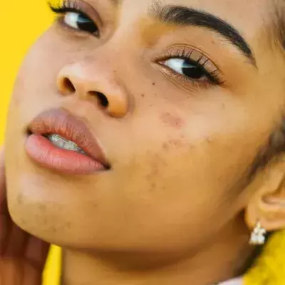 Understanding Your Acne Scars and How To Treat Them