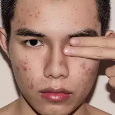 What Causes Acne?