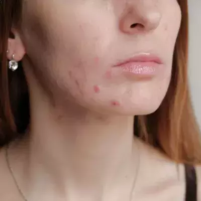 What Is Post-Inflammatory Erythema and How To Treat It