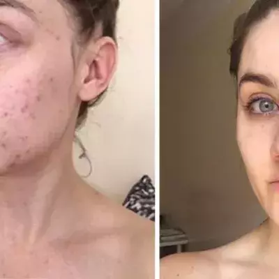 This Woman Stopped Washing Her Face For Six Months And Cured Her Acne