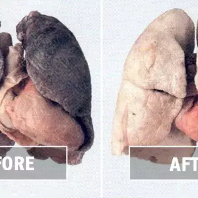 Smoking