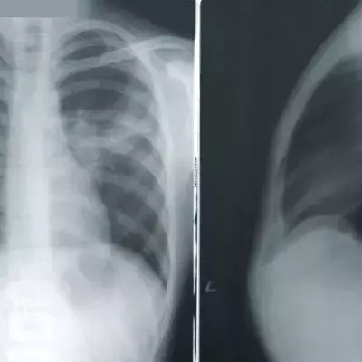 COVID x rays