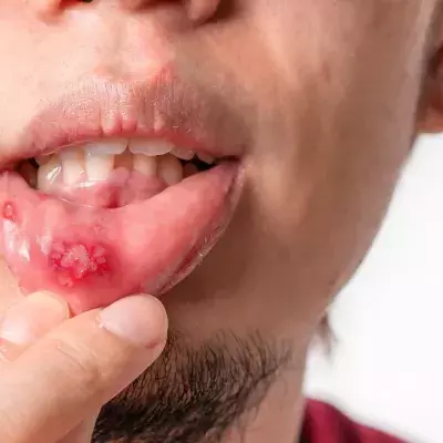 Cold sore
