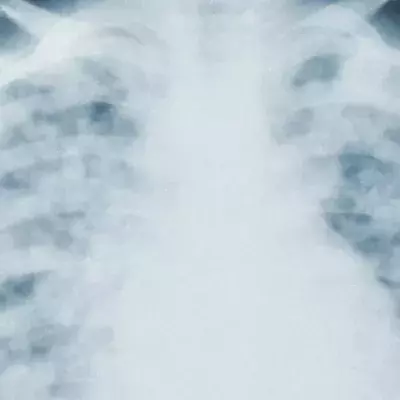 COVID pneumonia