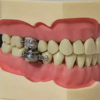 The device only allows the mouth to open by 2mm