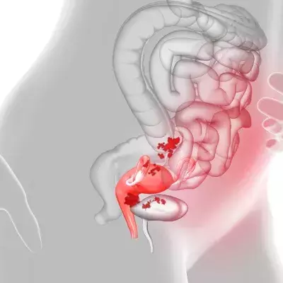 Endometriosis