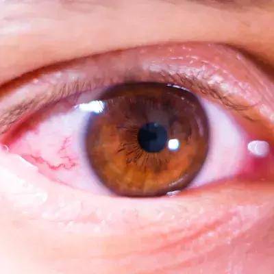 eye infarction danger