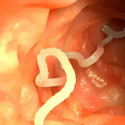 He Pulled A 10-Meter Tapeworm From His Backside