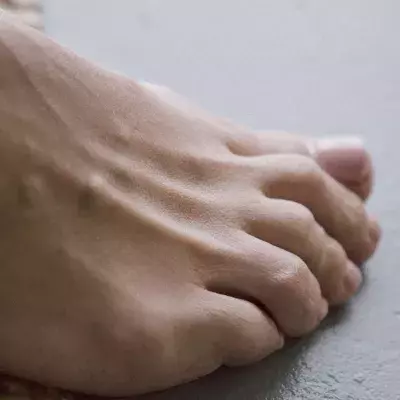 High cholesterol toenails health condition