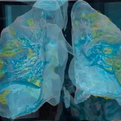 How the coronavirus affects the lungs can be seen for the first time in this video