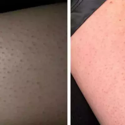 Keratosis pilaris