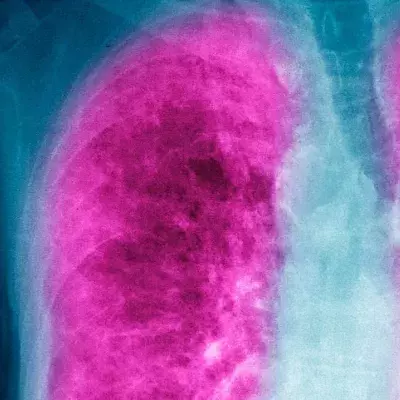 Lung cancer warning signs