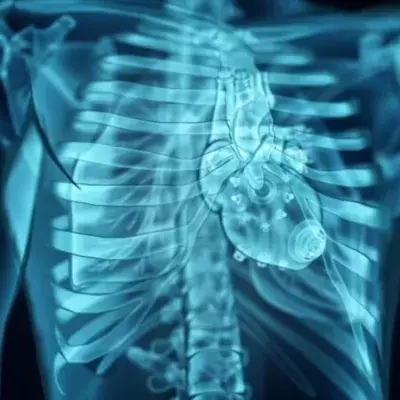 LVAD no heart beat Left Ventricular Assist Device