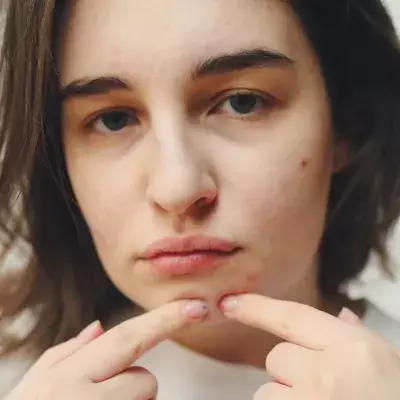 popping pimple danger triangle on face brain infection