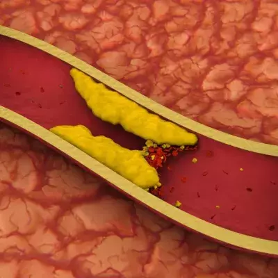 What is venous thrombosis, and do COVID vaccines cause it?