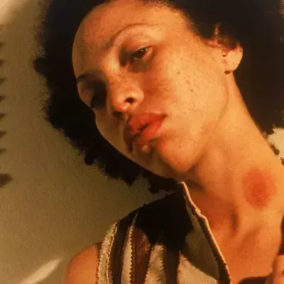 How to get rid of Hickeys quickly?