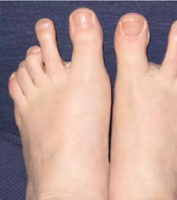 When the first two toes are a LOT longer than the rest of your toes!