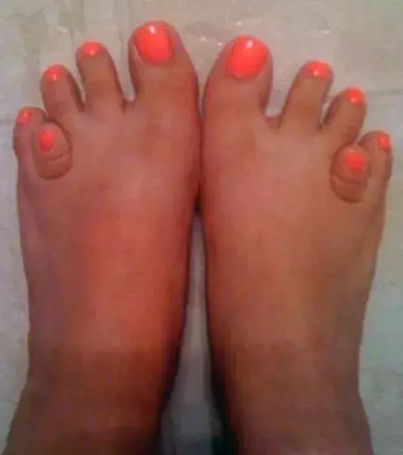 When one of your toes is so scrunched compared to the others!