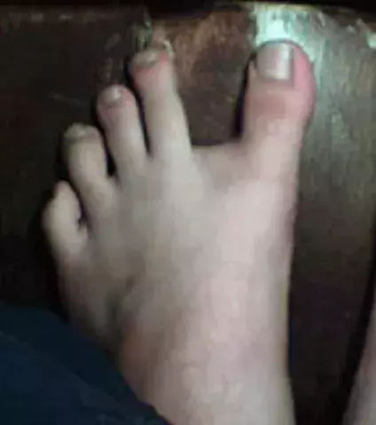 When there is a huge gap from your big toe to the second toe!