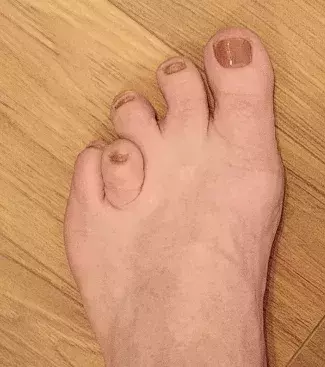When your small toe overlaps your other toes!