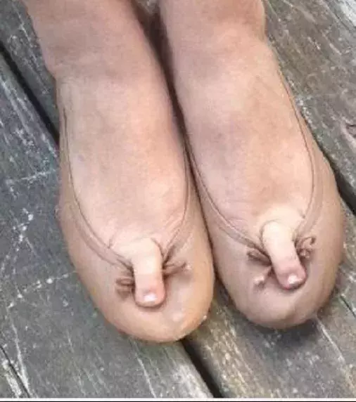 When your toes cannot fit into your shoes properly!