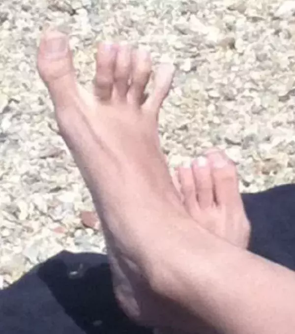 When your toes have huge spaces between them!
