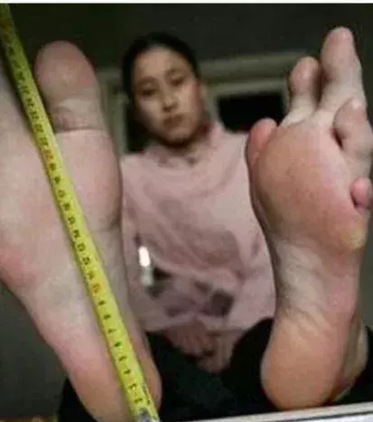 When your toes just don't line up properly!