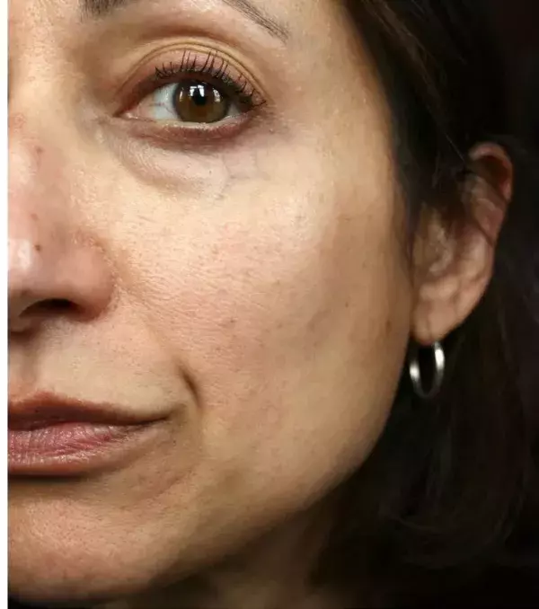 Before: DD cream stands for daily defense. It is used to protect the skin against pollution and UV rays. It also helps minimise wrinkles.