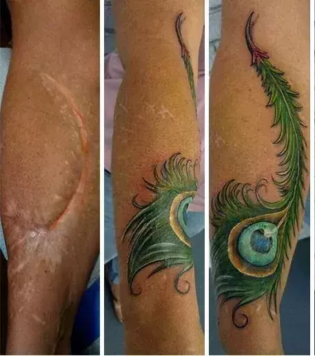 The peacock feather: Feather designs help minimise the appearance of the odd-shaped scars