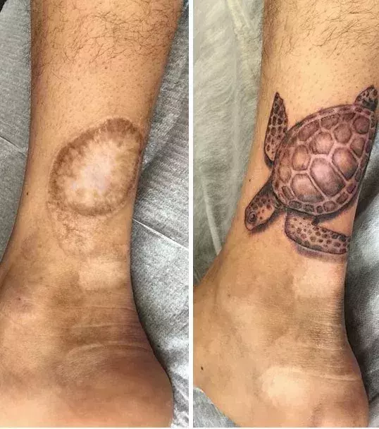 The turtle: Animal images go well with circular-shaped scars
