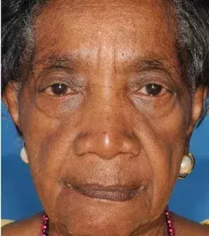 Her twin sister has smoked for several years and has bags under her eyes and quite a wrinkly mouth