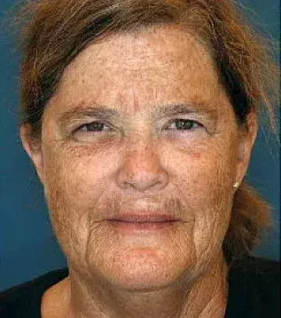 Her twin sister smoked for 16 years and has had a lot of sun exposure 