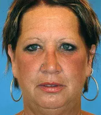 This twin has also had a lot of sun exposure but has never smoked in her life