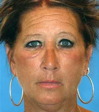 This woman smokes half a pack of cigarettes a day and has had a lot of sun exposure
